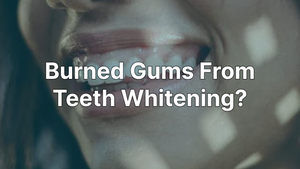 Burned Gums From Teeth Whitening? What You Should Know